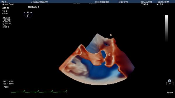3D view of adult left atrial appendage