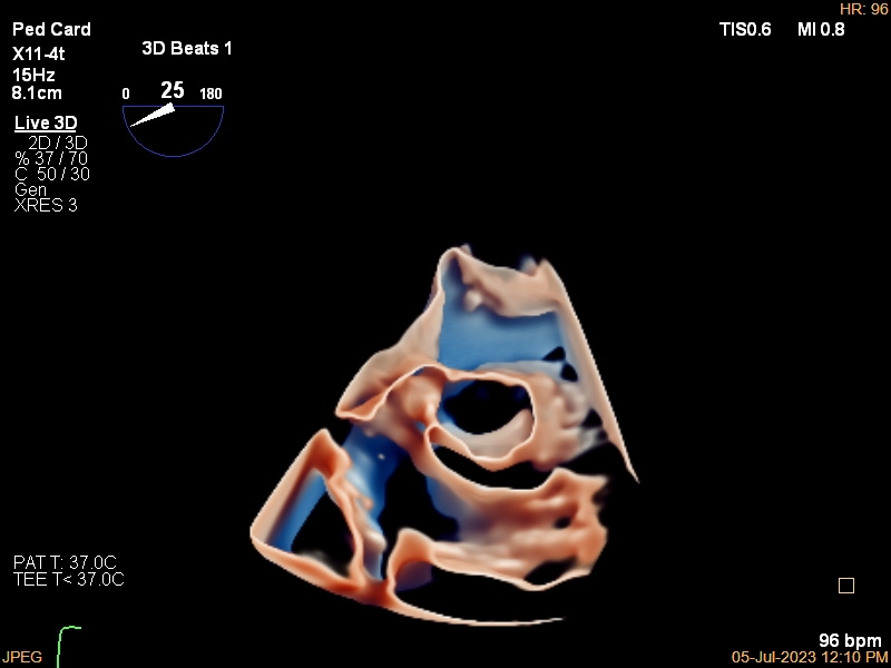 3D View of young pediatric patient heart view