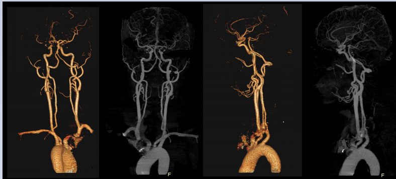 Precise Suite Incisive carotid 