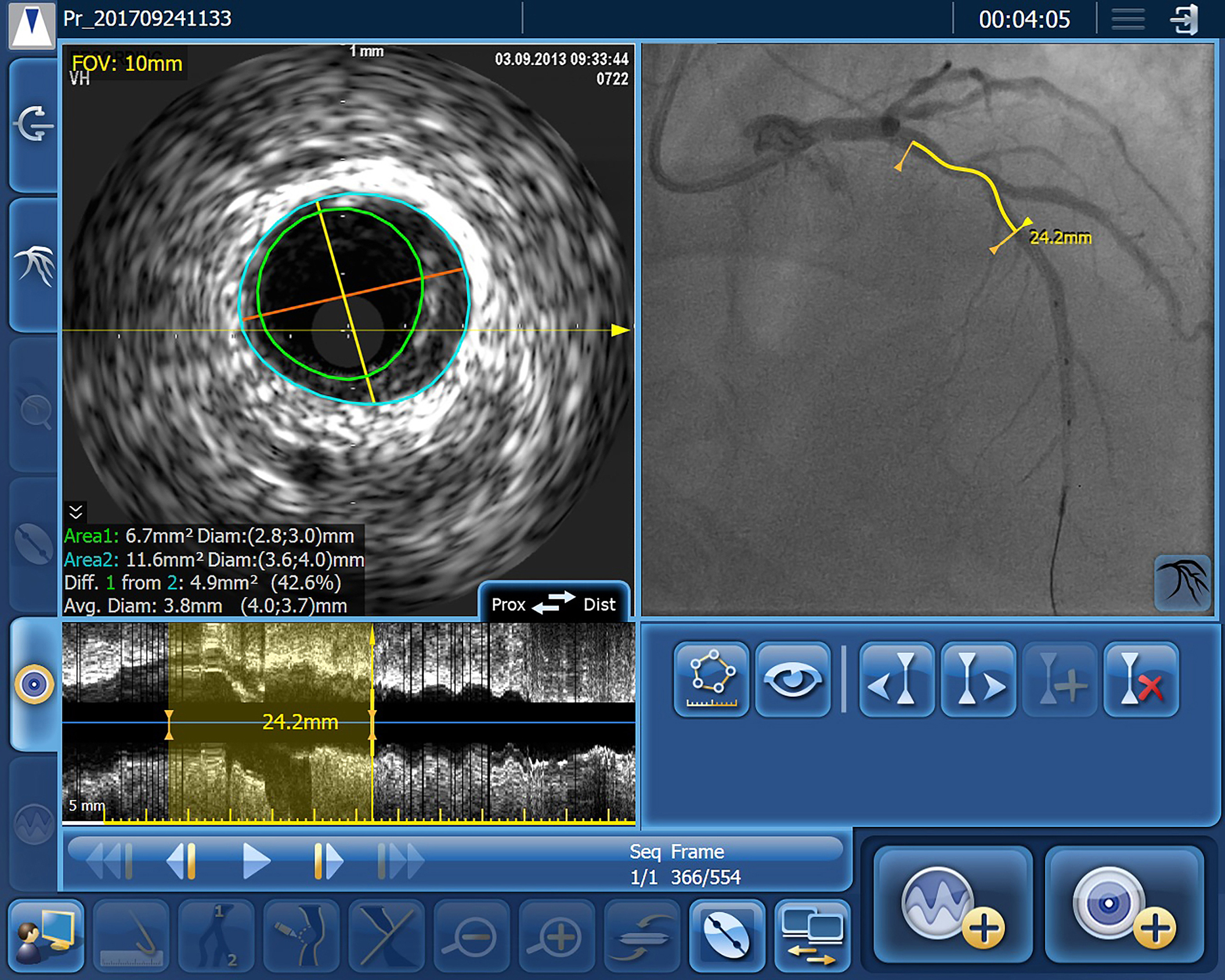 Philips intravascular ultrasound (IVUS)