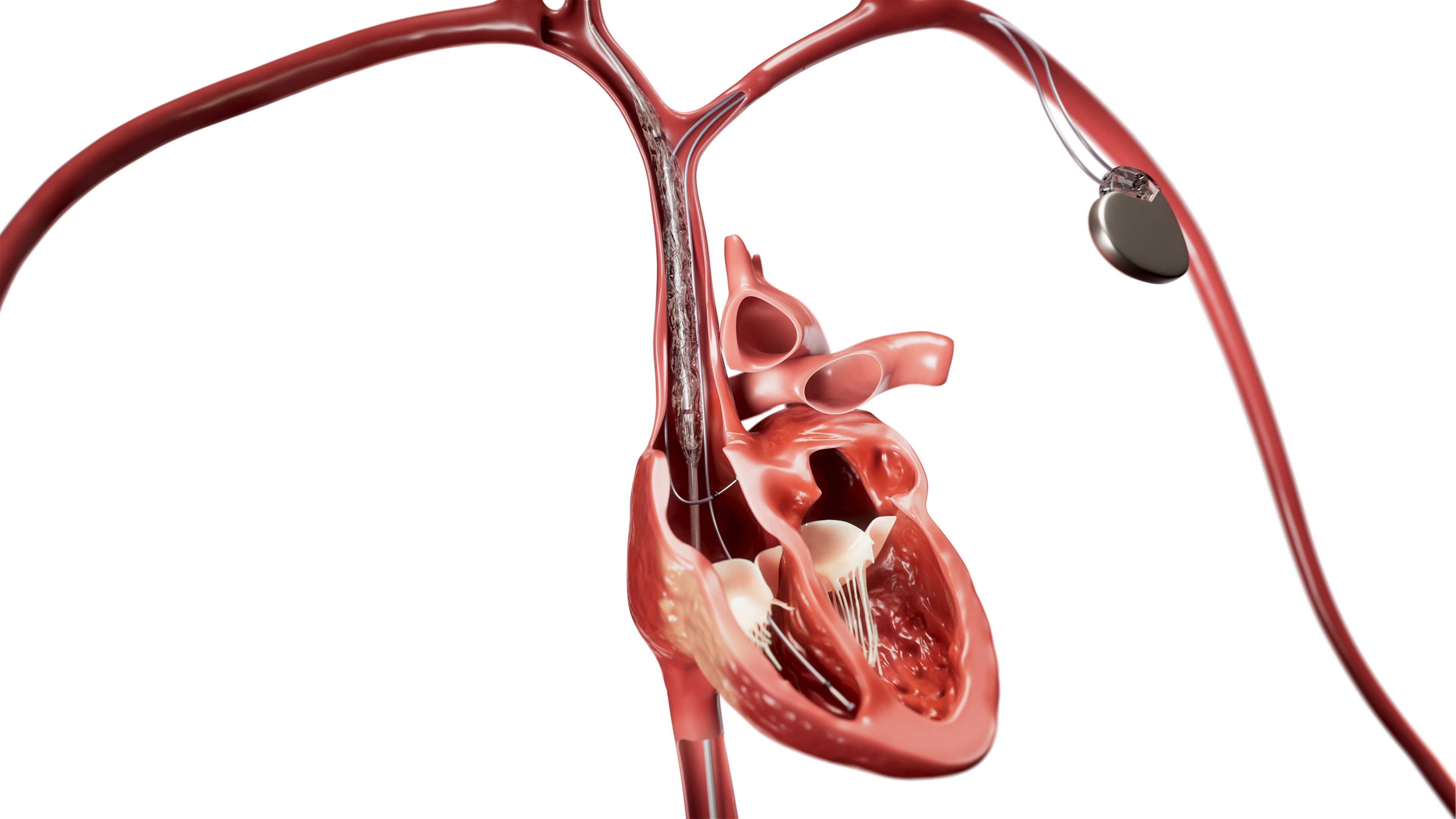 Clinical illustration of the Philips Bridge Plus balloon in use