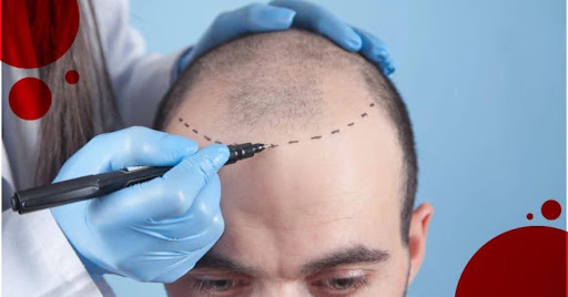 Istanbul Care Announces Updated 2026 Hair Transplant Packages for International Patients Traveling to Turkey