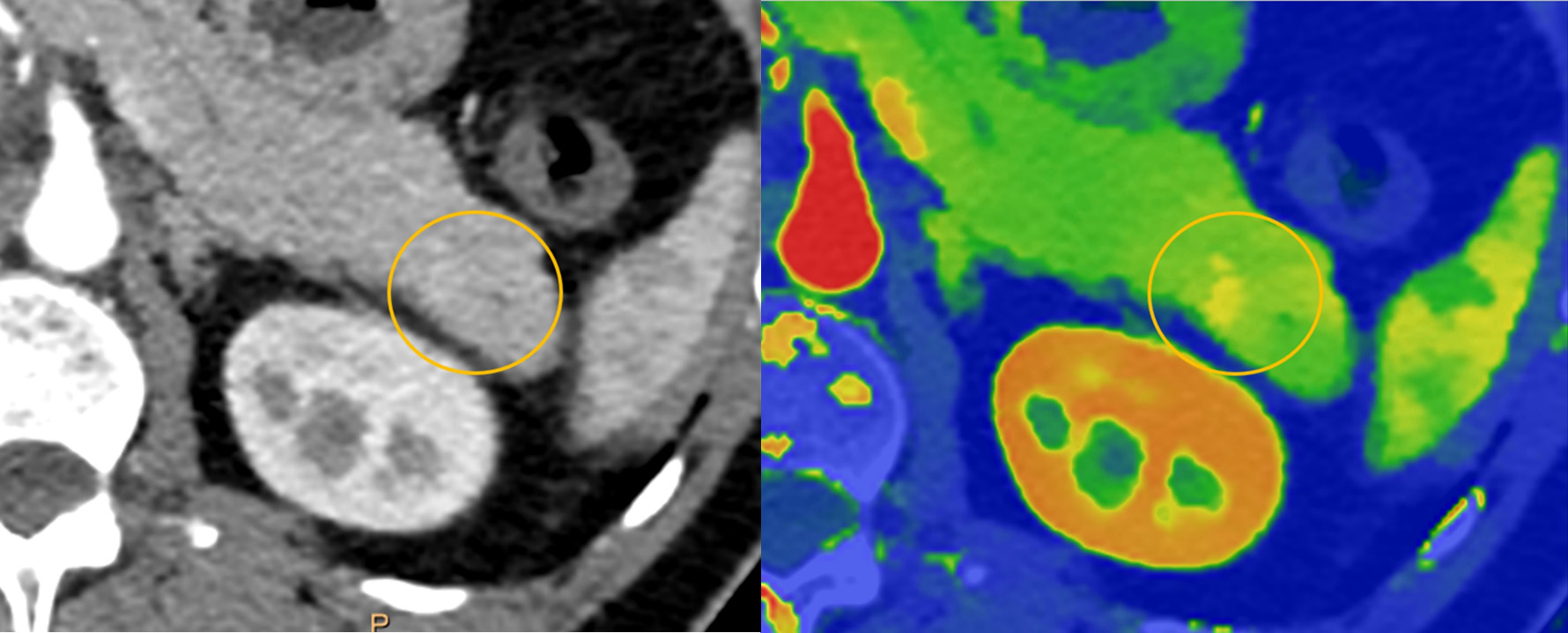 Spectral CT 7500 Pancreatic Lesion Comparison