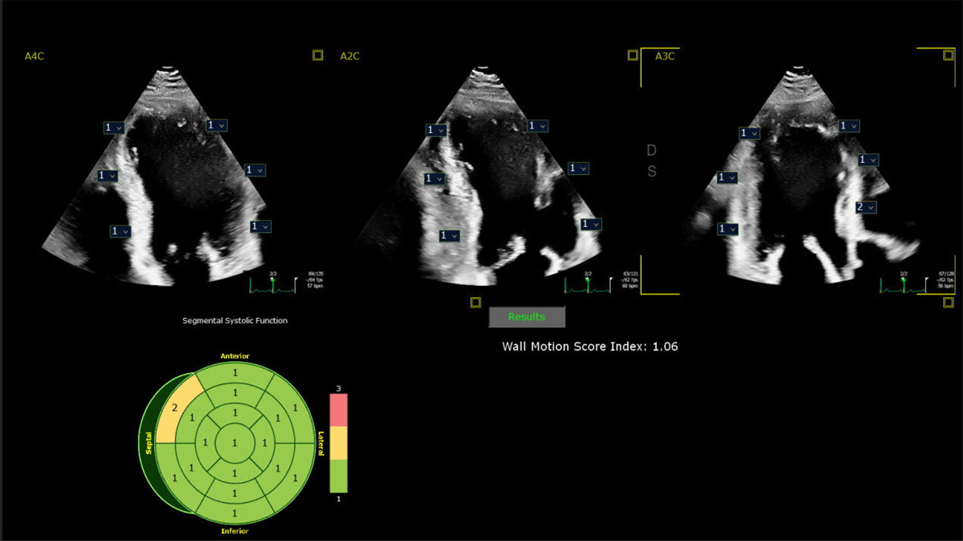 Clinical image showing how integrating AI into cardiac ultrasound provides automated segmental wall motion scoring