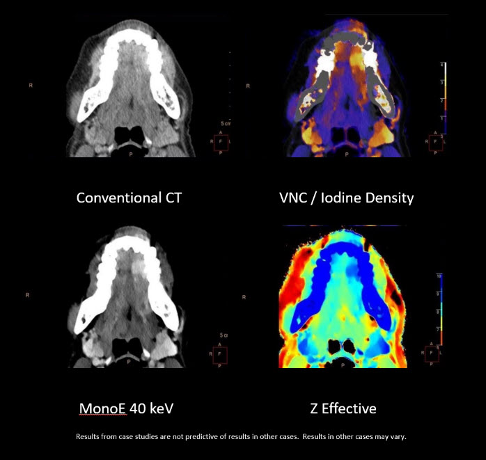 Spectral CT 7500 RT clinical