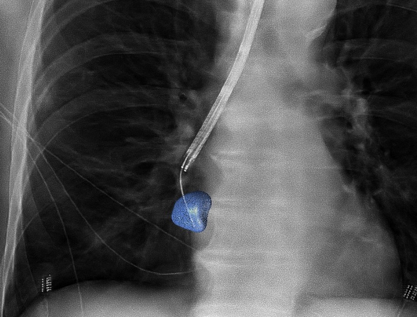 Lung biopsy using Philips 3D navigation - 2