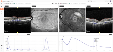 A look at the Discovery CORE platform and its AI. Features displayed include the overlay of AI on OCT images to visualize fluid and layers, side-by-side imaging comparisons on two different time-points or visits, and at the bottom, progression plots for retinal fluid volume of a patient over time.