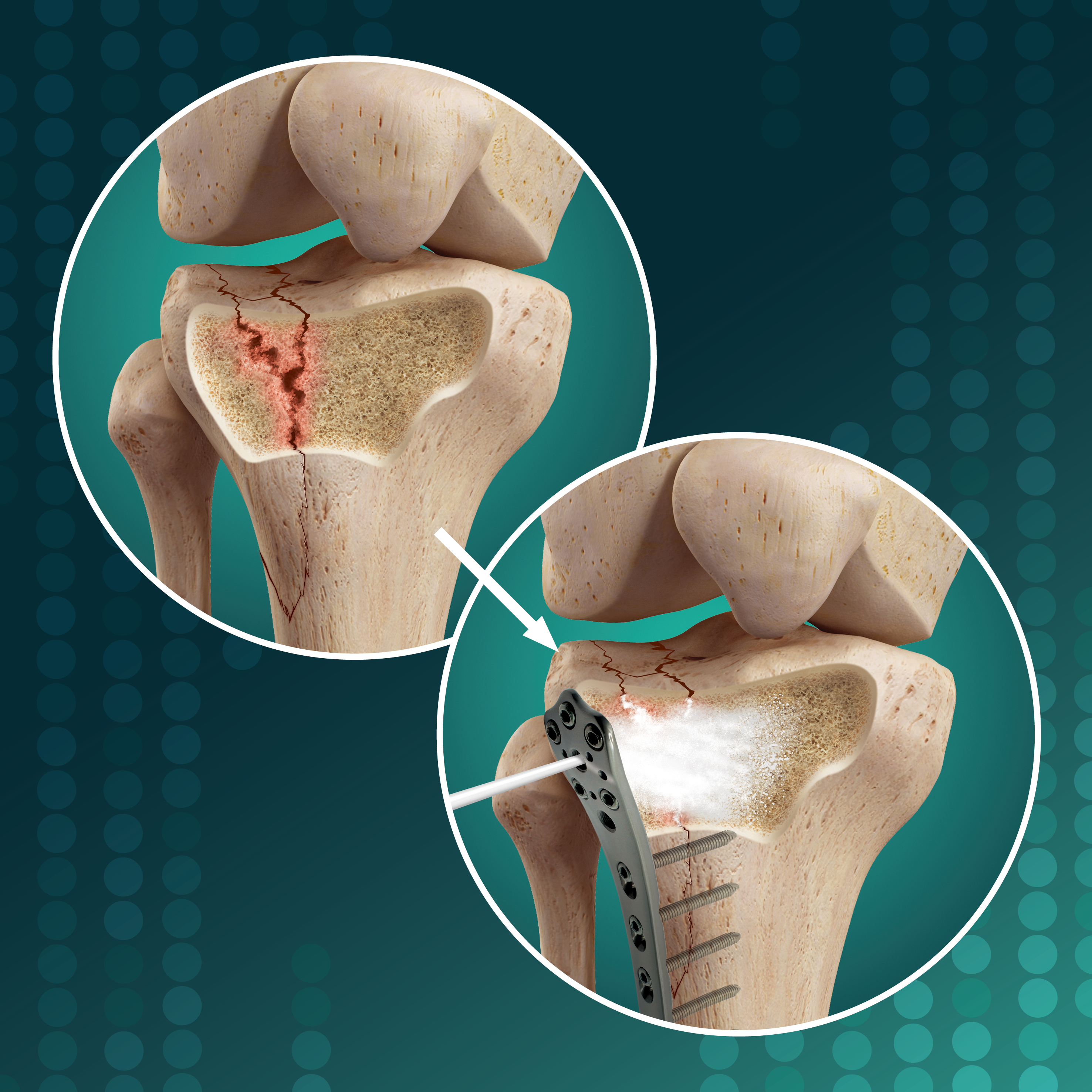 OsStic™ Injectable Synthetic Bone Void Filler in Tibial Plateau Fracture Fixation