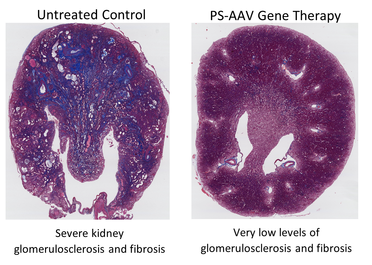 Purespring gene therapy significantly improves kidney morphology and reduces the areas of scarring and fibrosis stained in blue.