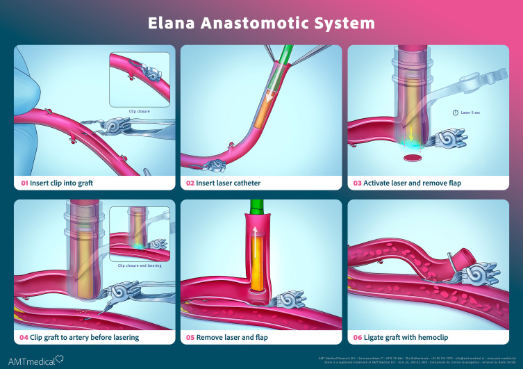 Six steps ELANA coronary bypass system