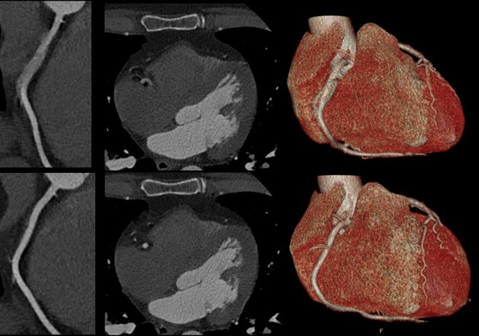 Spectral CT 7500 Motion in Right Coronary Artery Comparison