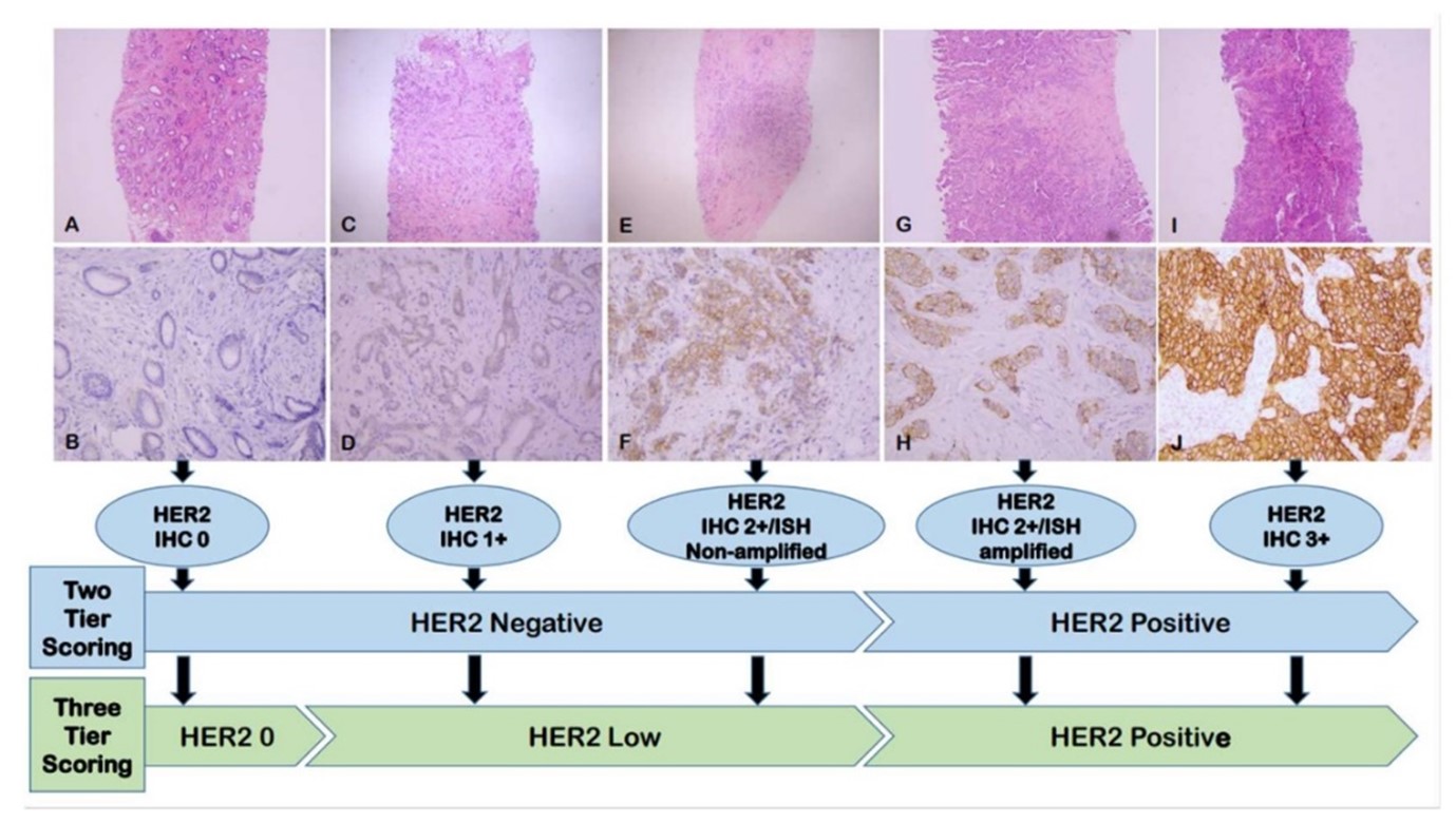 Current paradigm of HER2 expression scoring