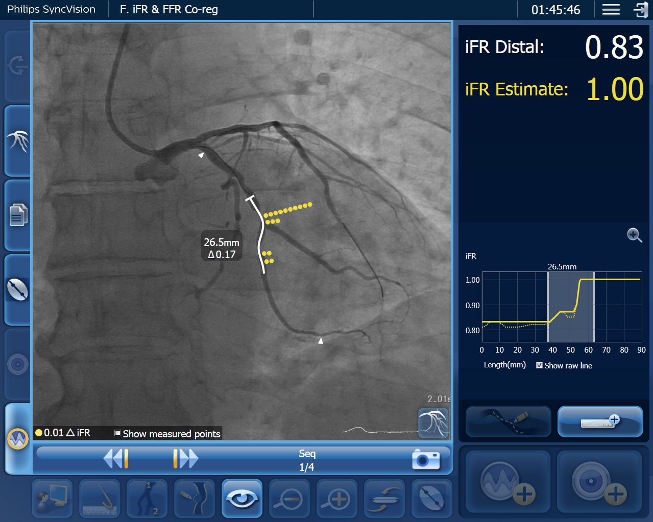 Philips iFR