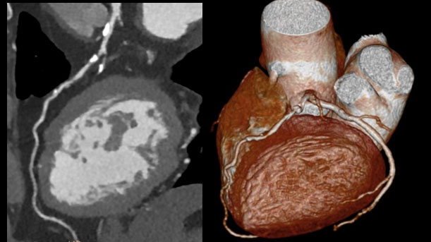 Precise Suite Incisive cardiac