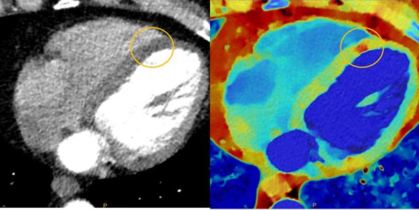 Spectral CT 7500 Myocardial Perfusion Comparison