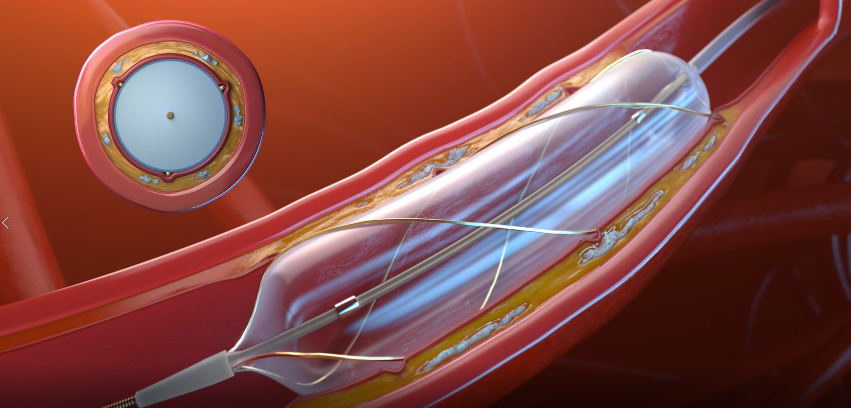 Philips Scoring Balloon Catheter RX – AngioSculpt Evo