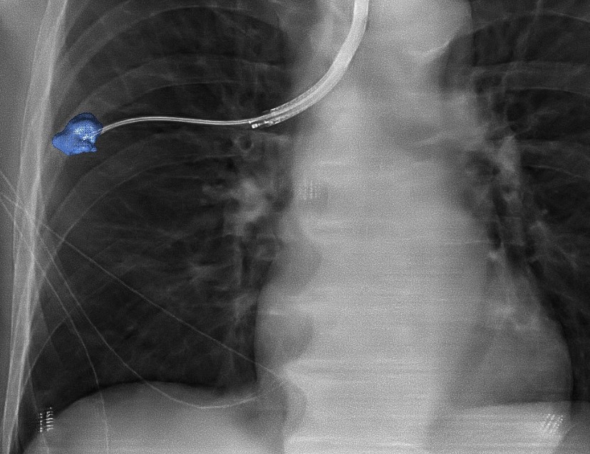 Lung biopsy using Philips 3D navigation - 1