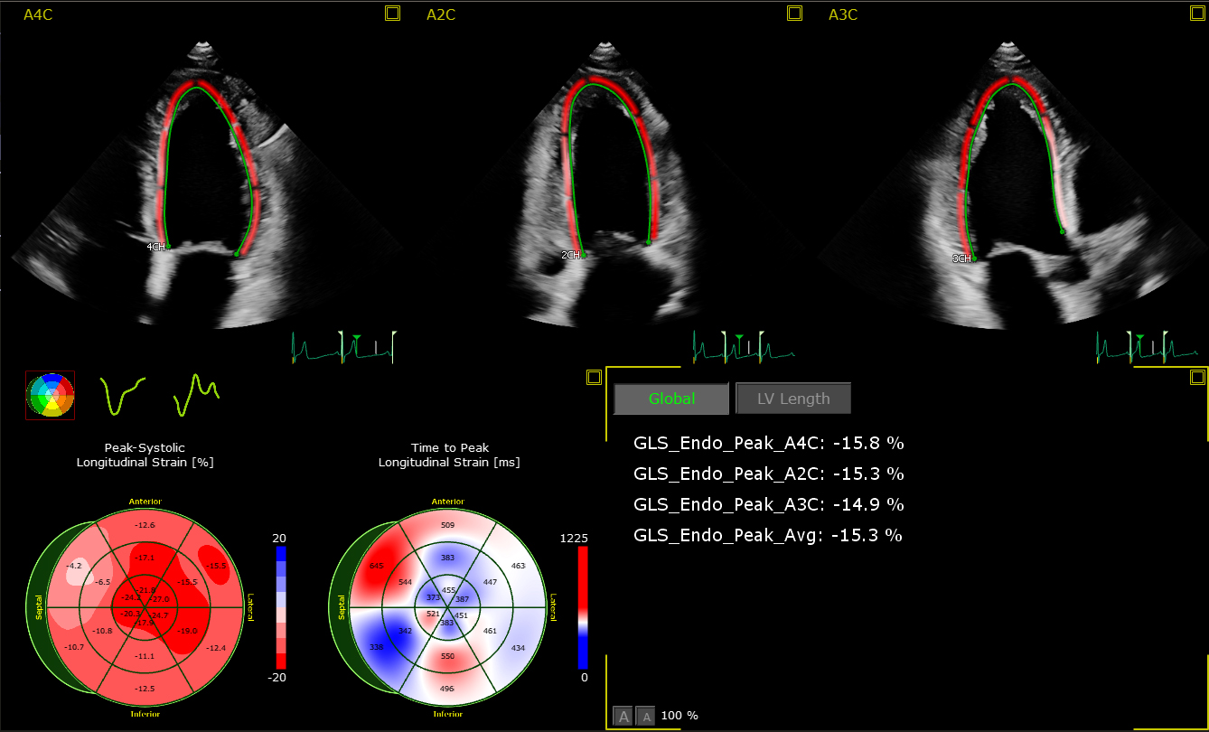 Advances in echocardiography: global longitudinal strain, intra-cardiac  multidirectional flow imaging and automated 3d volume analysis