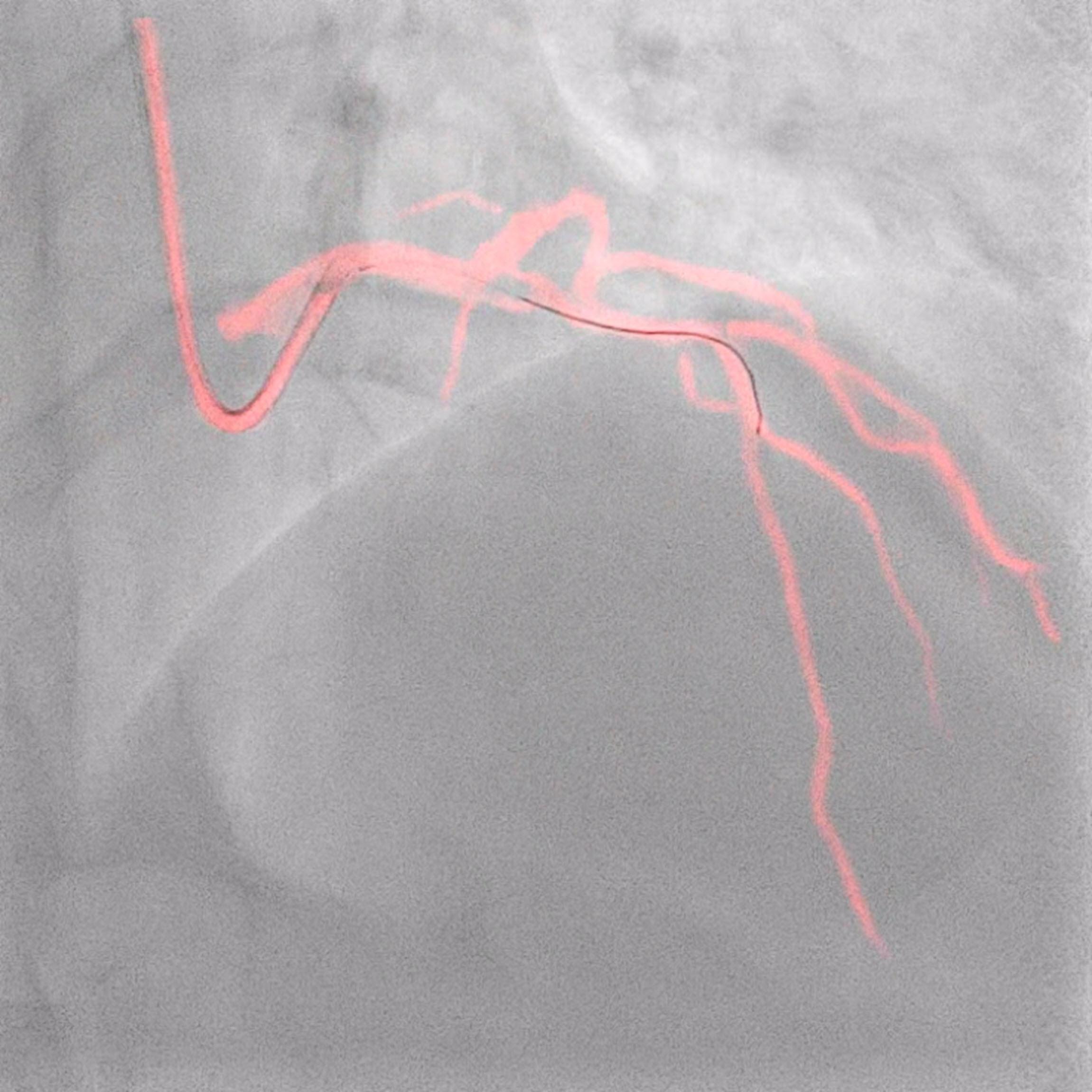 Philips Dynamic Coronary Roadmap