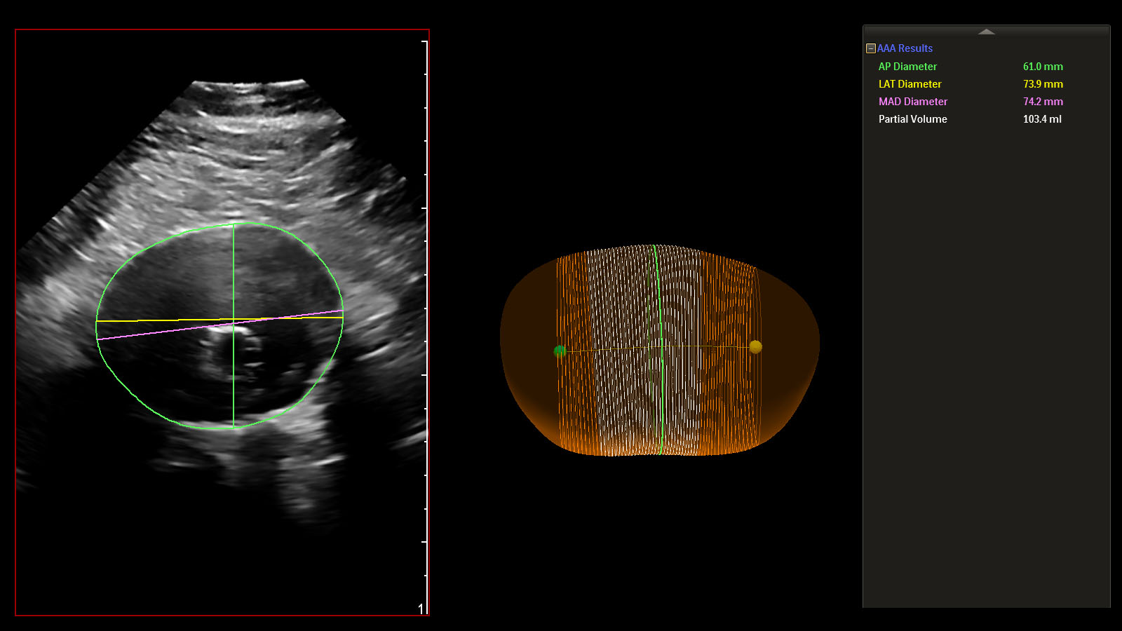 Philips AAA model results