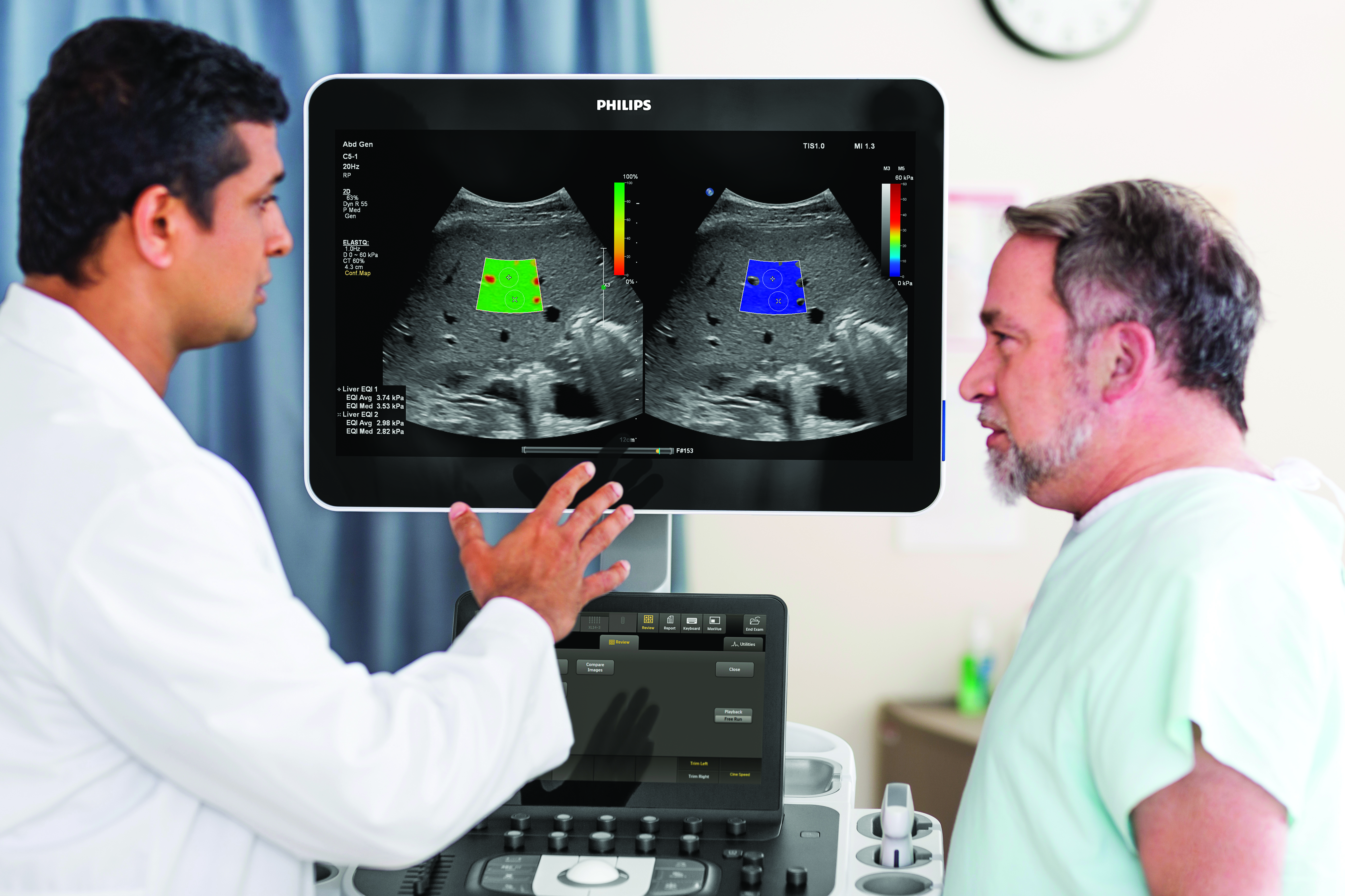 Philips-ultrasound-liver-fat-quantification
