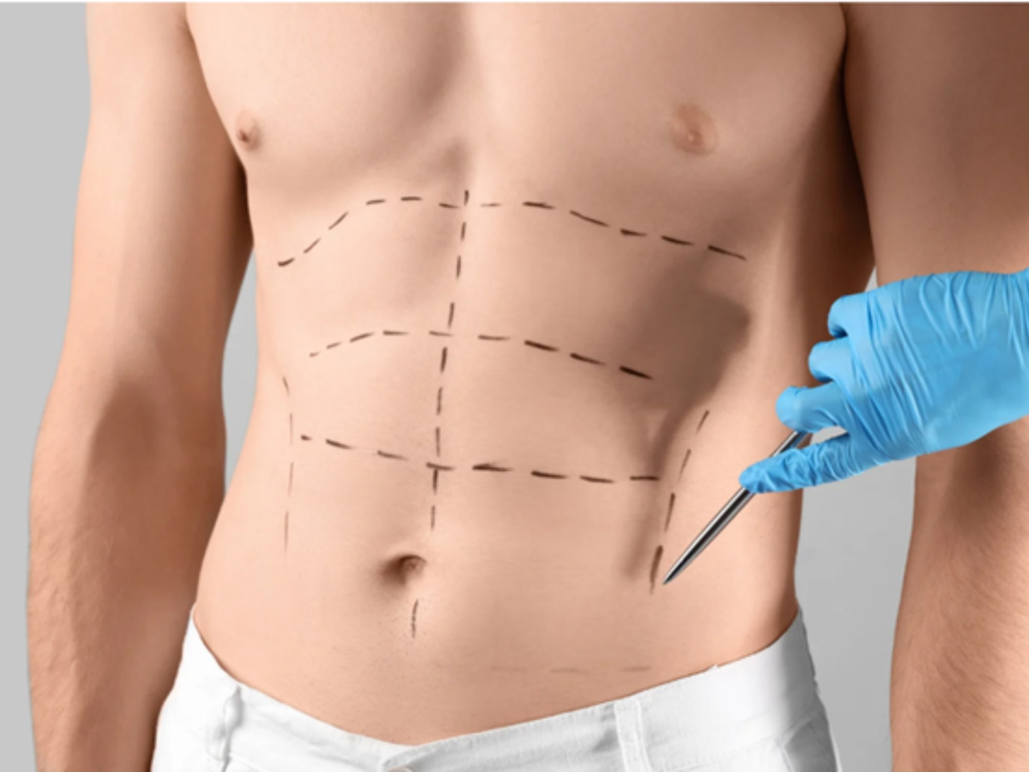 tummy tuck in Dubai