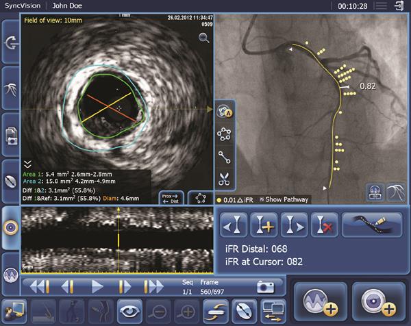 iFR data co-registered on the angiogram