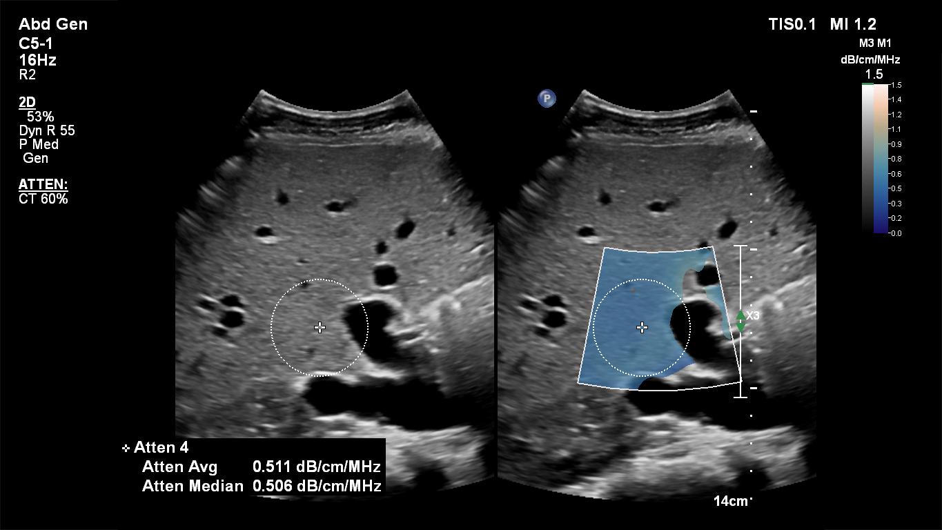 EPIC Ultrasound GI Liver image 2