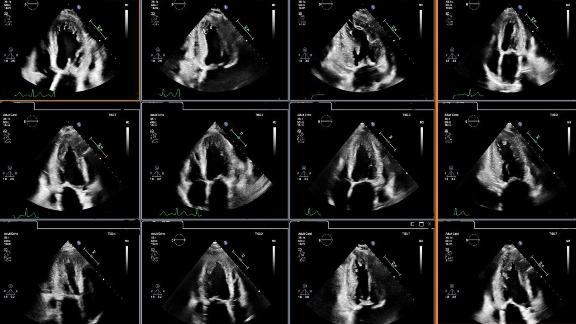 Clinical image showing cardiac ultrasound display for image analysis enhanced through integration of AI.